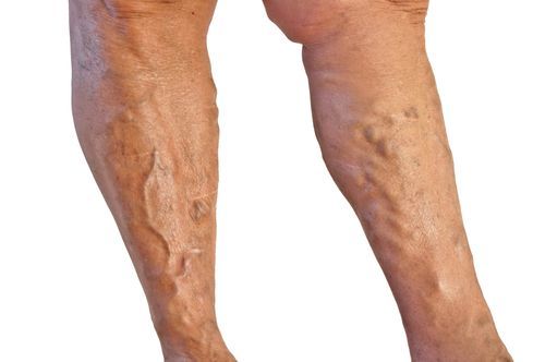 What is a venous insufficiency treatment?