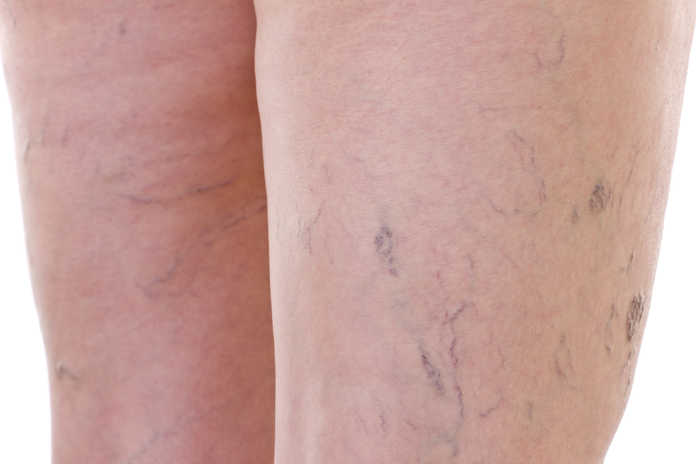 Reasons You Need to Schedule a Vein Screening | Varicose Vein Treatment Center | South Baldwin