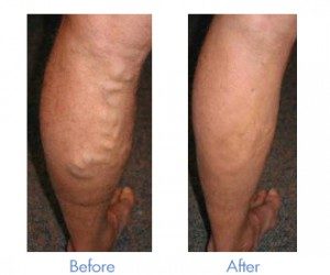 ultrasound guided foam sclerotherapy before & after