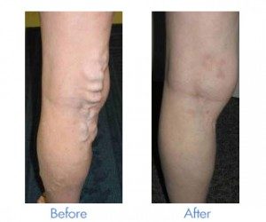 varicose vein treatment before and after