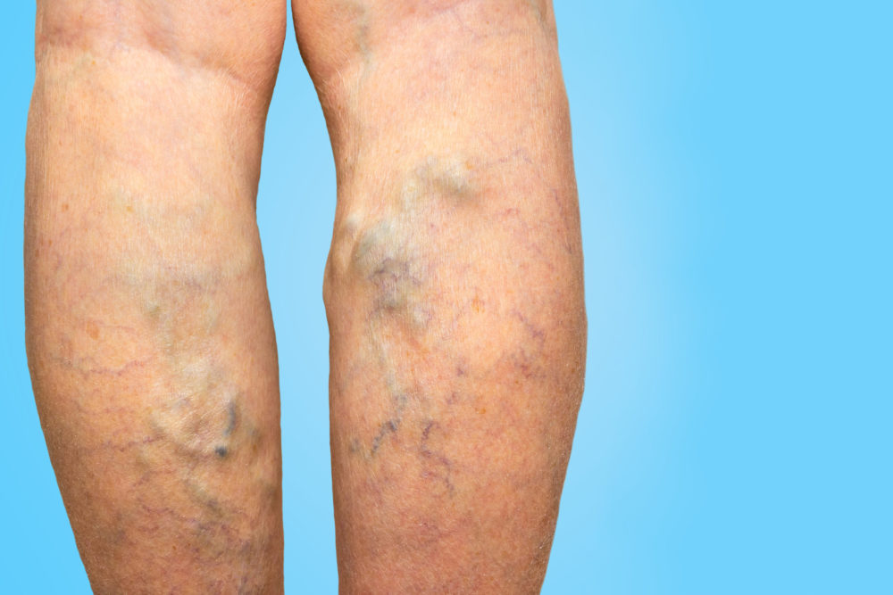 Varicose Veins Vs. Spider Veins: What's The Difference?