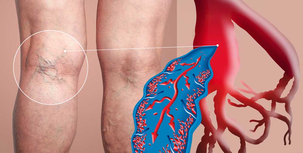 5 reasons not to put off varicose vein treatment