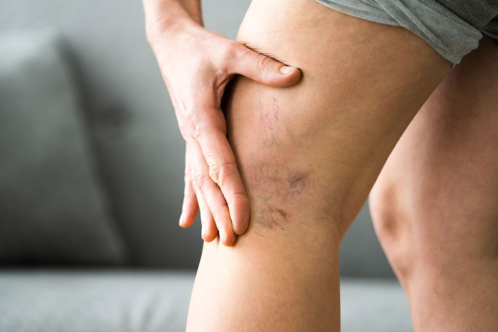 Causes of Spider Veins - Vein Solutions